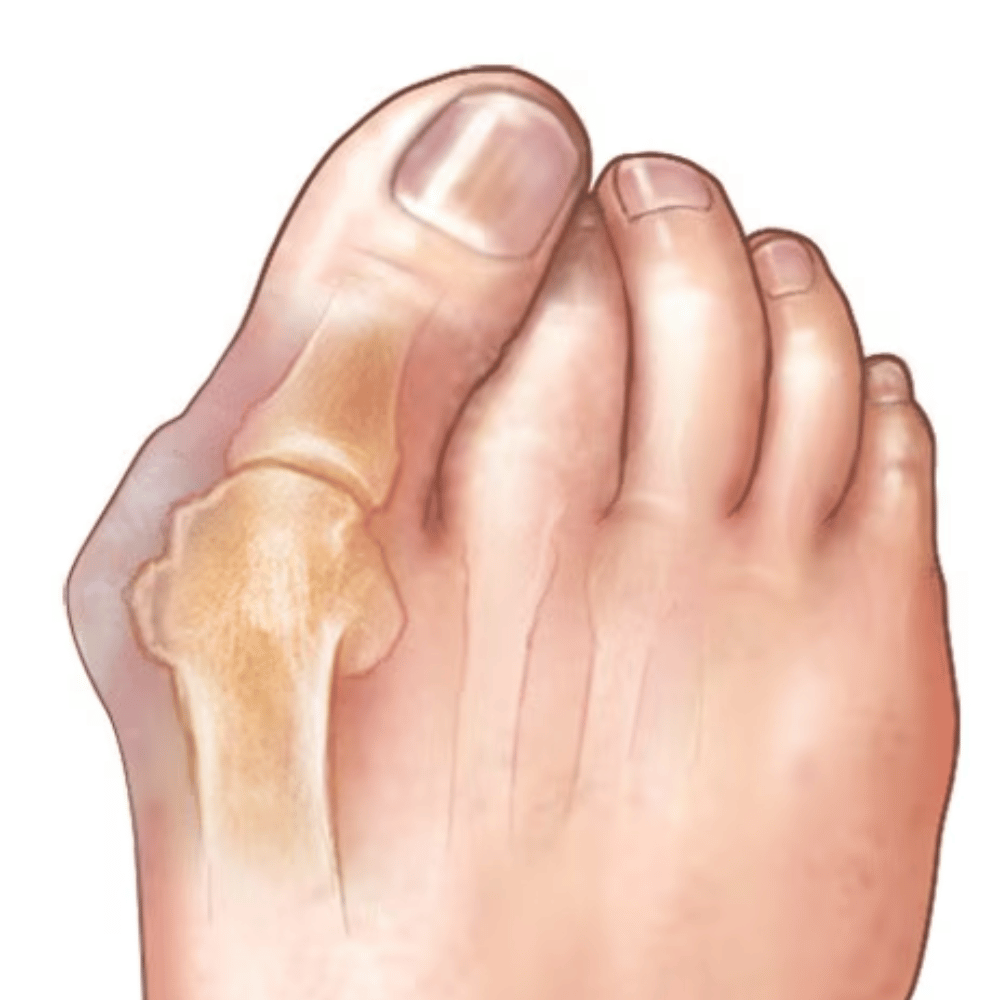 Do Insoles Help Bunions? A Podiatrist's Guide to Easing Bunion Pain