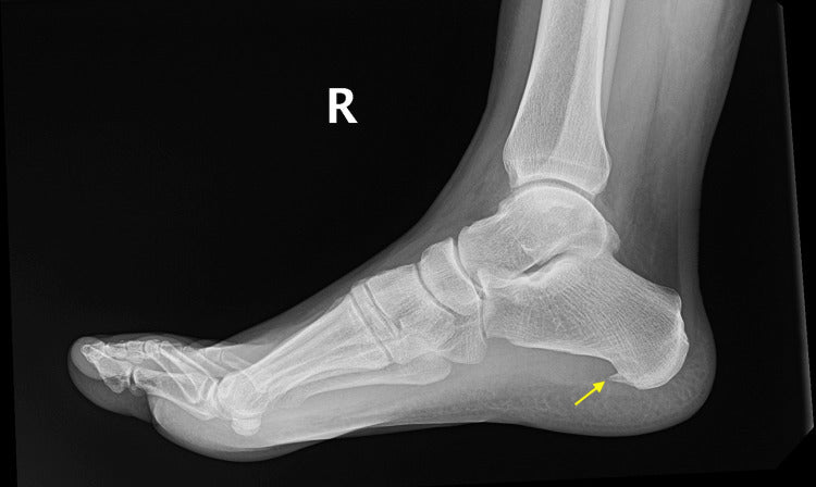Heel Spurs vs Plantar Fasciitis: How to Tell Which One You Have