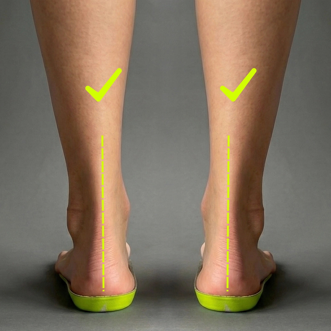 Image showing the improved alignment of feet and ankles while using SOLE5 orthotic insoles.