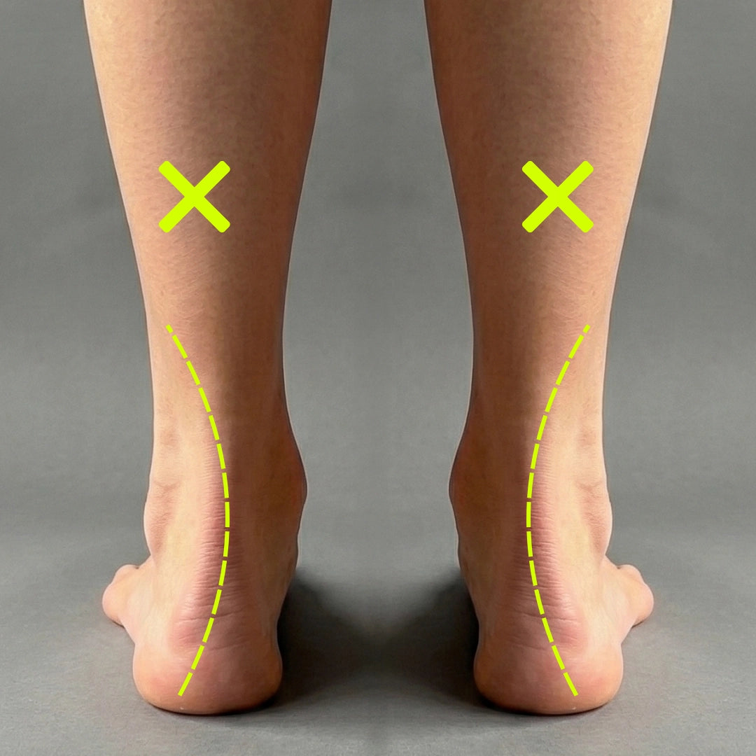 Image showing the poor alignment of feet and ankles without using SOLE5 orthotic insoles.